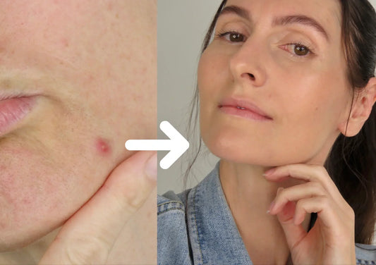Natural Makeup for Teenage Acne
