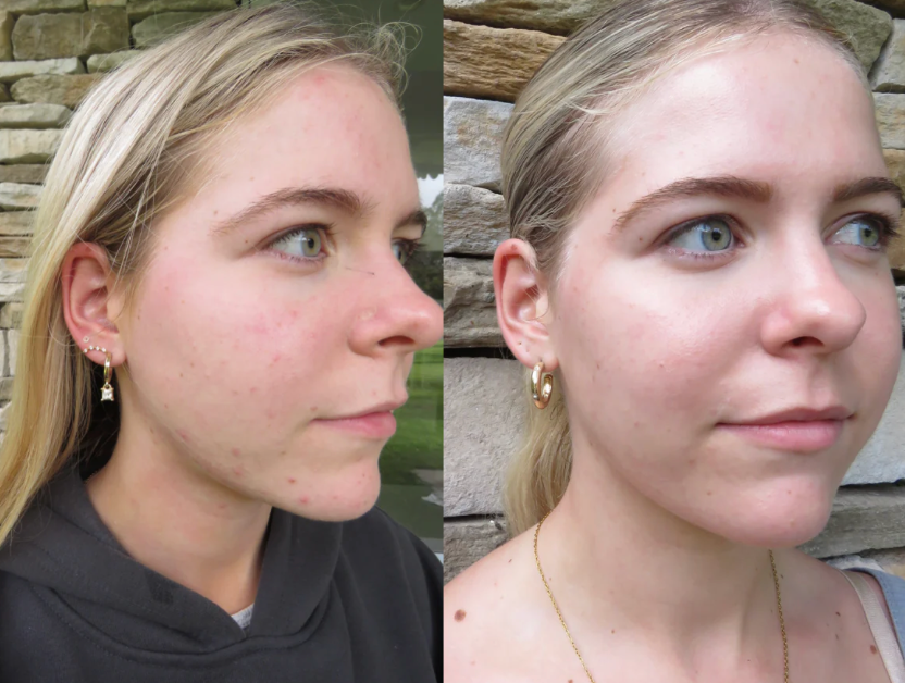Teen Clear Skin Discovery Set