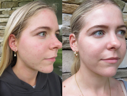 Teen Clear Skin Discovery Set